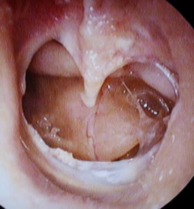hearing reconstructive surgeries, large central perforation of eardrum