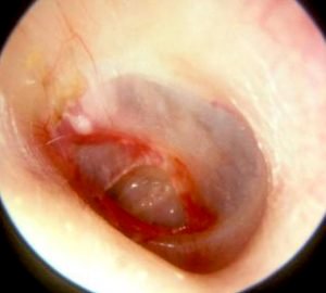 hearing reconstructive surgeries, traumatic central perforation of ear drum traumatic central perforation of ear drum