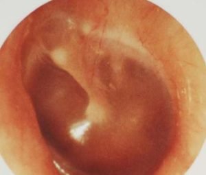 hearing reconstructive surgeries, glue ear glue ear, fluid block behind eardrum