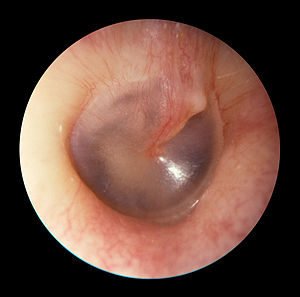 Hearing reconstructive surgeries, normal eardrum normal eardrum