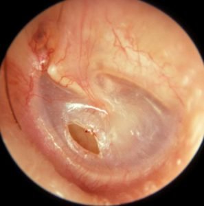 hearing reconstructive surgeries, small central perforation of eardrum
