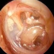 hearing reconstructive surgeries, retracted eardrum retracted ear drum