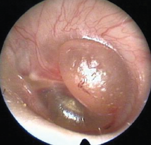 hearing reconstructive surgeries, bulging eardrum bulging eardrum